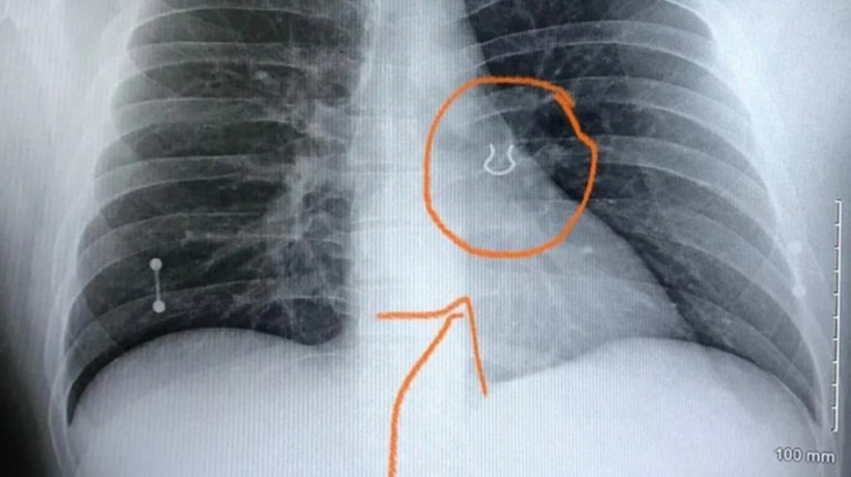 Piercing que estava há cinco anos no pulmão de paciente é encontrado