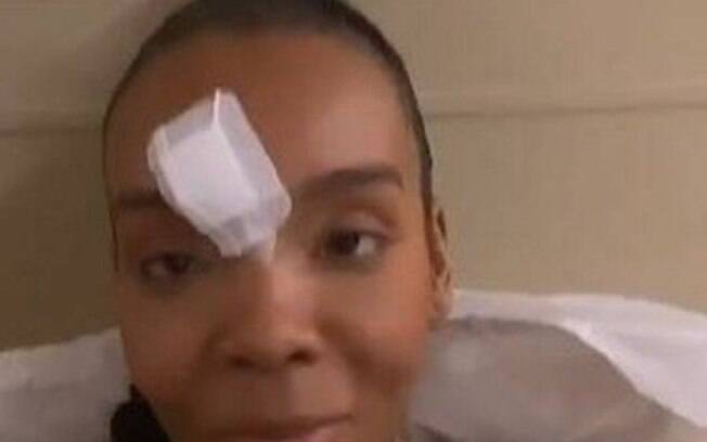 Thelma Assis com curativo na testa