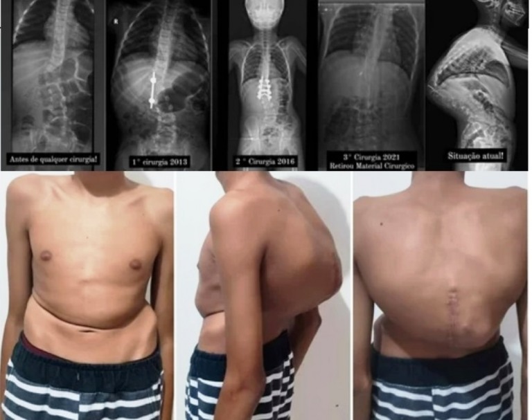 Família de Lupércio pede ajuda por cirurgia complexa, cara e pouco tempo após anos na fila