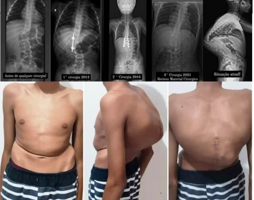 Família de Lupércio pede ajuda por cirurgia complexa, cara e pouco tempo após anos na fila