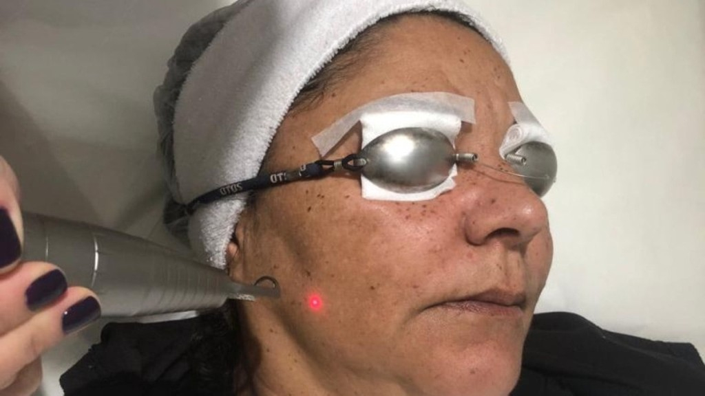 Arquivo pessoal A aplicação é feita na área afetada pelo melasma