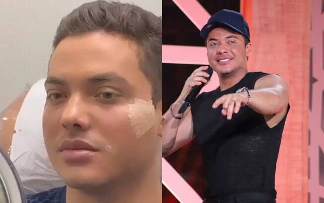 Wesley Safadão fez harmonização facial