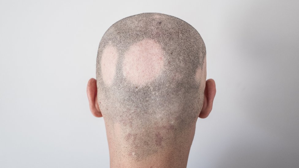 Homem com alopecia areata, que resultou em manchas calvas no couro cabeludo