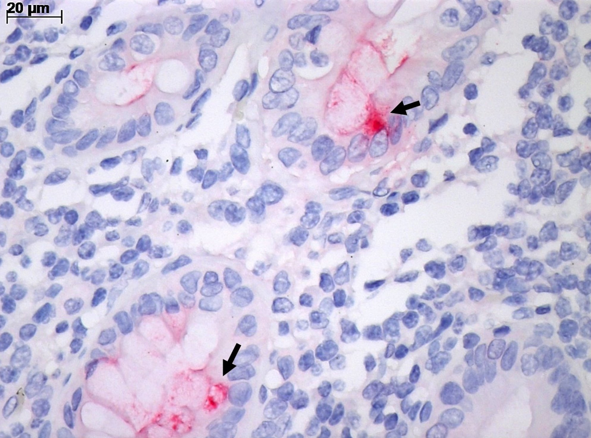 Intestino com inflamação pela Covid-19