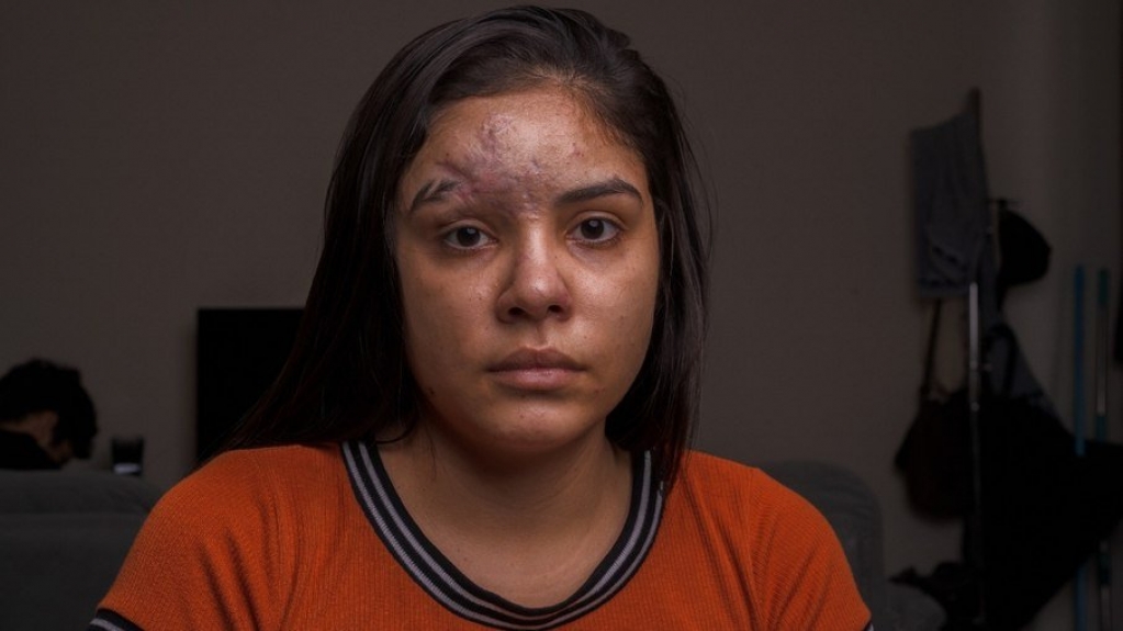 Um ano após acidente, jovem fará 3ª cirurgia de reconstrução do rosto
