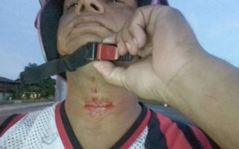 Homem que teve pescoço cortado por linha chilena diz que foi salvo por óculos