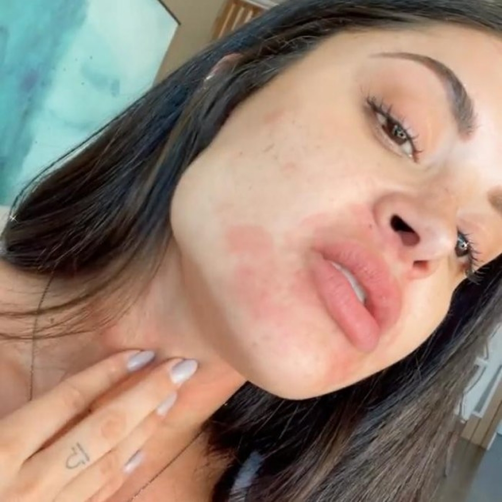 Aline Riscado mostra manchas causadas por alergia aos 16 gatos dela