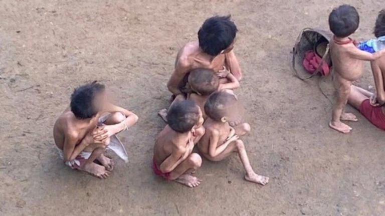 Caso Yanomamis: como ocorre a desnutrição?