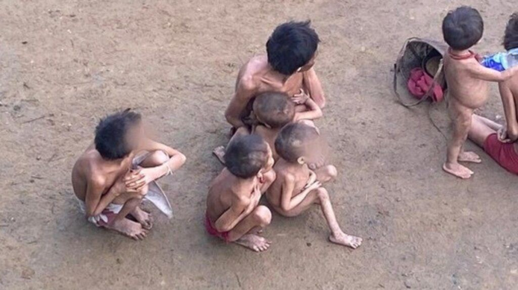 Caso Yanomamis: como ocorre a desnutrição? Caso Yanomamis: como ocorre a desnutrição?