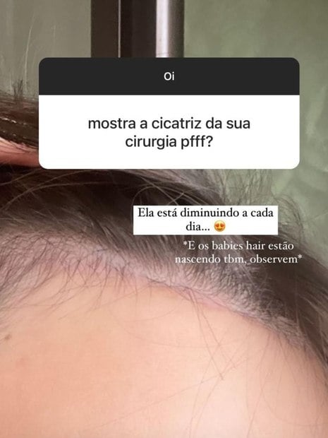 Cicatriz de Thais Braz após cirurgia para reduzir a testa