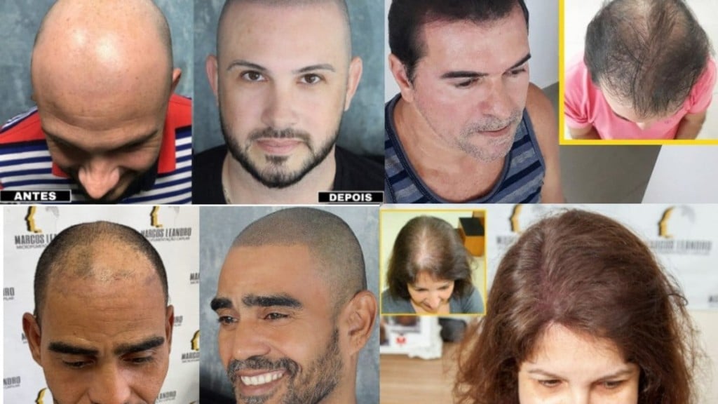 Divulgação Especialista e criador da técnica 4D, Marcos Leandro ajuda a reconstruir o aspecto visual capilar de pessoas que sofrem com problemas como calvície, alopecia e cicatrizes