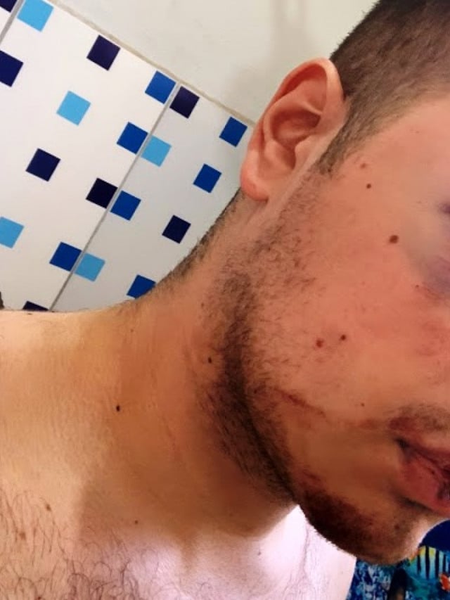Jovem vítima de acidente faz vaquinha para cirurgia em Marília