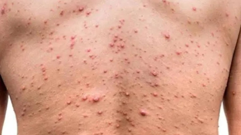 Estudo diz que encefalite e confusão mental são sintomas do monkeypox