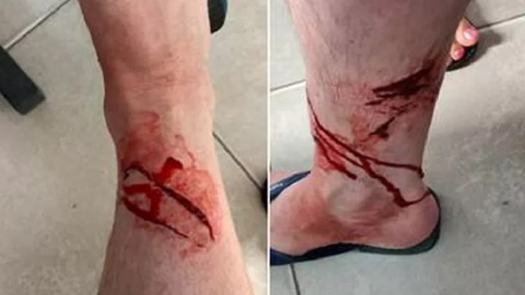 Turista francês foi atacado por tubarão em Ubatuba, confirmam pesquisadores Turista francês foi atacado por tubarão em Ubatuba, confirmam pesquisadores