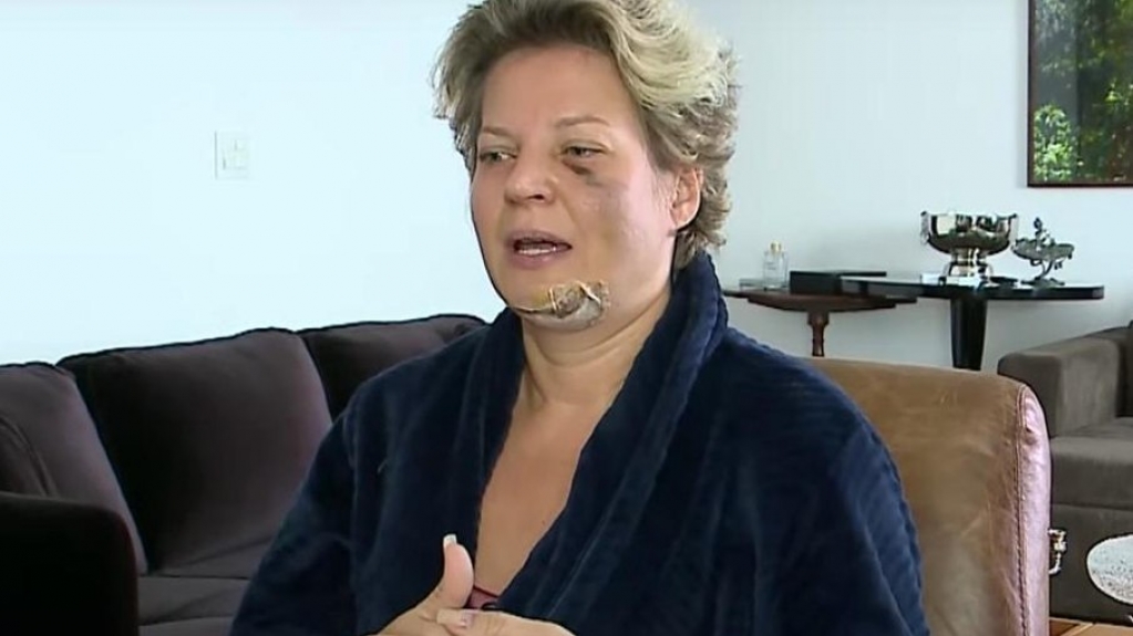 Caso Joice Hasselmann: Polícia atesta que deputada 'caiu da própria altura'