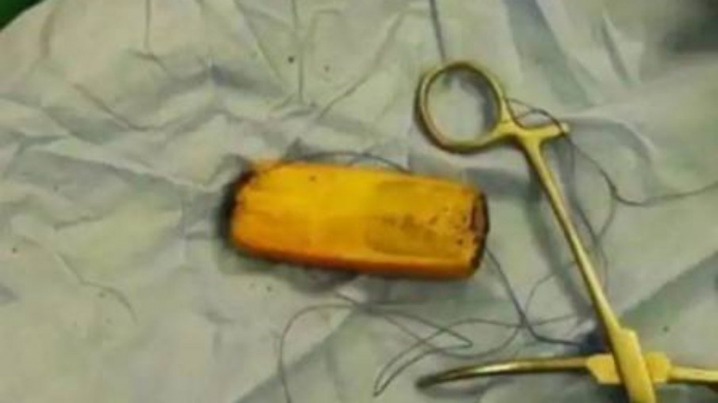 Homem engole celular, não consegue evacuar e acaba na mesa de cirurgia Homem engole celular, não consegue evacuar e acaba na mesa de cirurgia