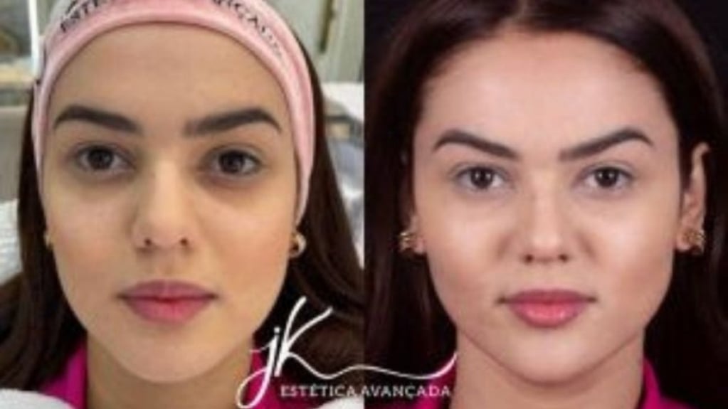 Eslovênia faz harmonização facial; veja antes e depois Eslovênia faz harmonização facial; veja antes e depois