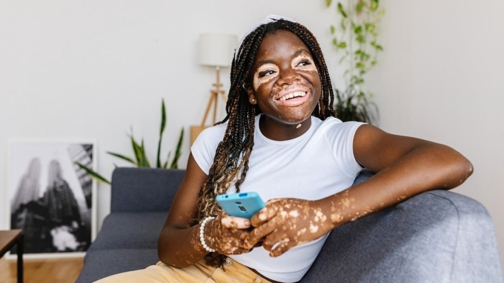 Foto: Reprodução Vitiligo: 3 cuidados fundamentais com a pele durante o verão