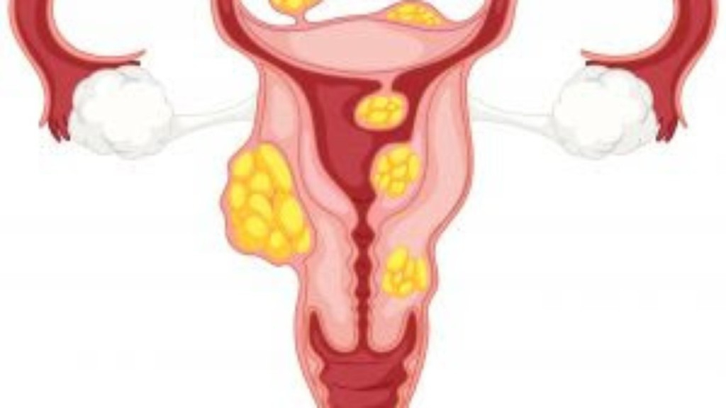 Divulgação Miomas uterinos afetam até 70% das mulheres, mas raramente levam à infertilidade feminina