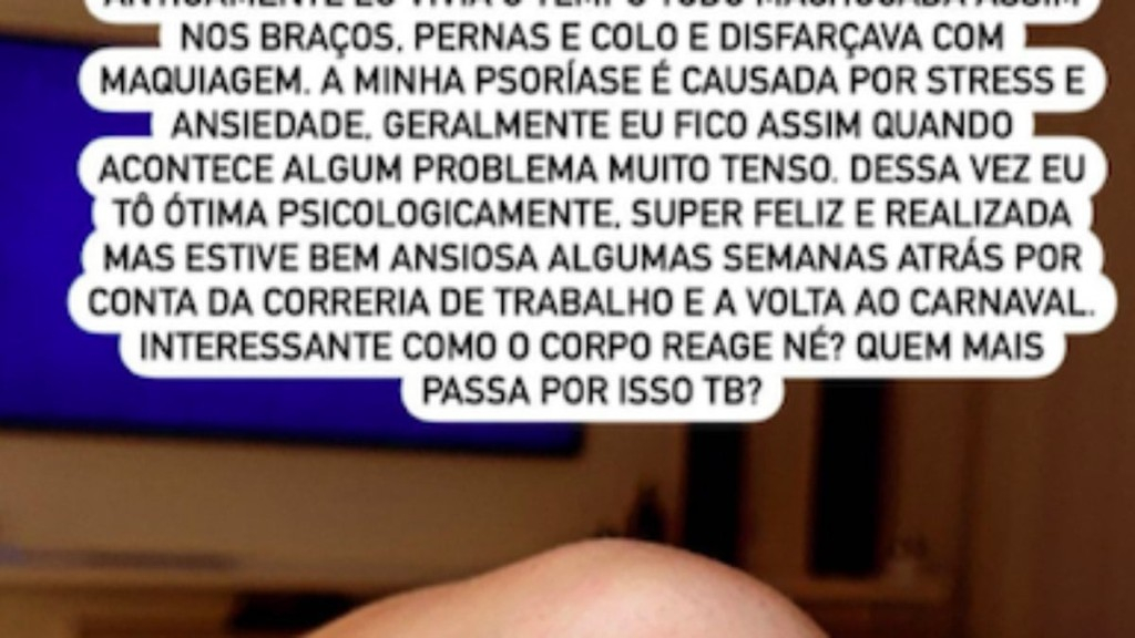 Reprodução/Instagram Juju Salimeni revela luta contra psoríase: “Disfarçava com maquiagem”