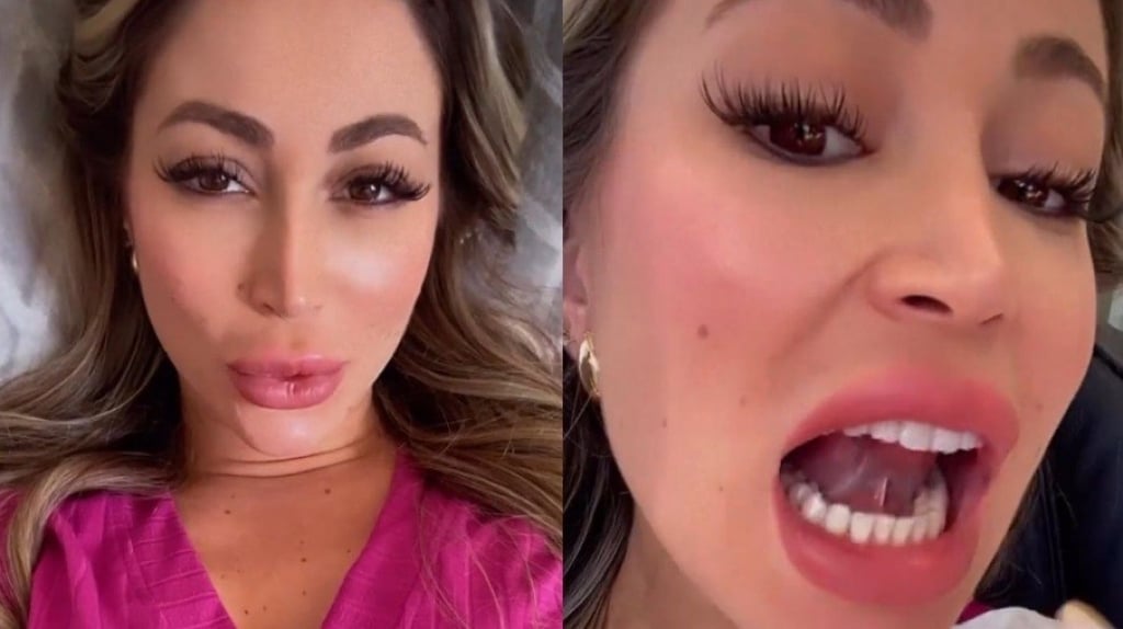 Carol Narizinho faz cirurgia para corrigir língua presa: "Atrapalha para beijar"