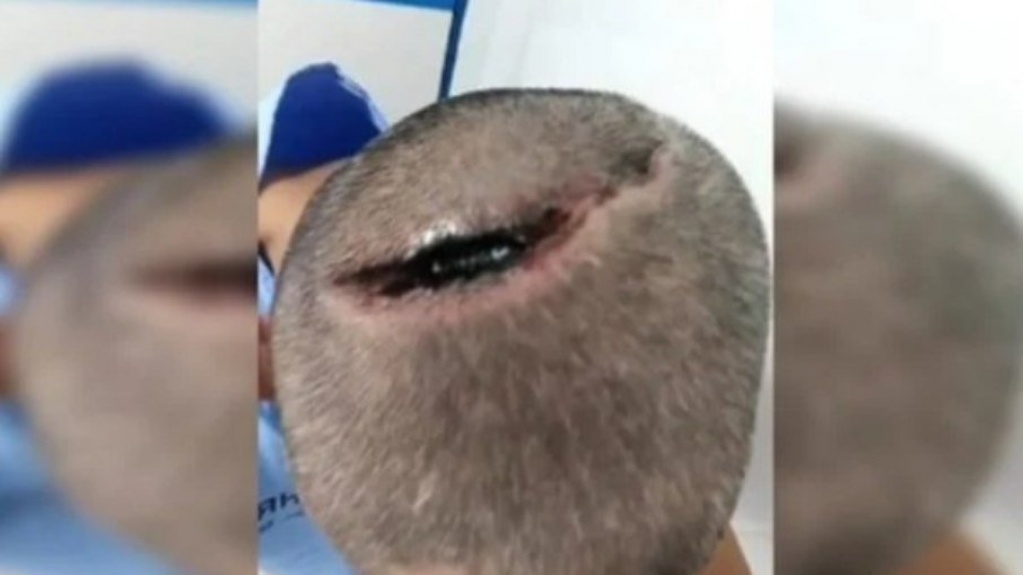 Paciente é intubado com Covid-19 e acorda com cabeça rachada; imagens são fortes