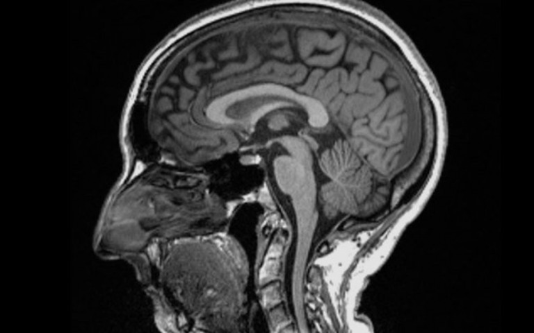 Covid-19: imagem revela como infecção pode alterar o cérebro