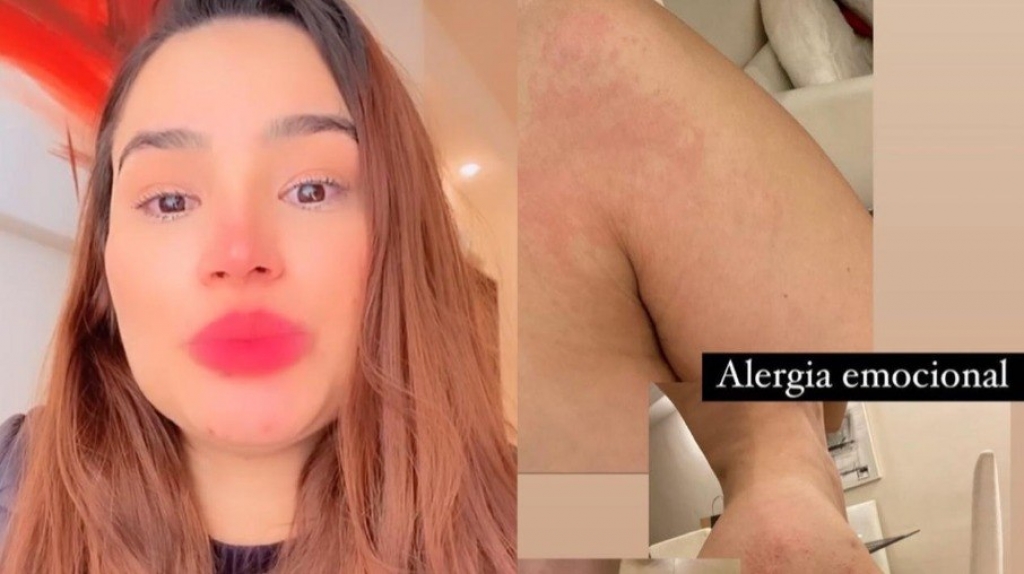 Raissa Barbosa chora e mostra fotos de alergia emocional após polêmica da vacina Raissa Barbosa chora e mostra fotos de alergia emocional após polêmica da vacina