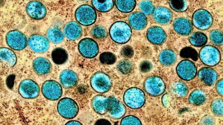 SP registra a 2ª morte por monkeypox