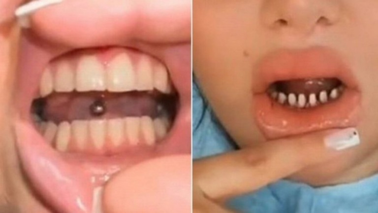'Assassinato de dentes' por 'sorriso perfeito', alerta dentista