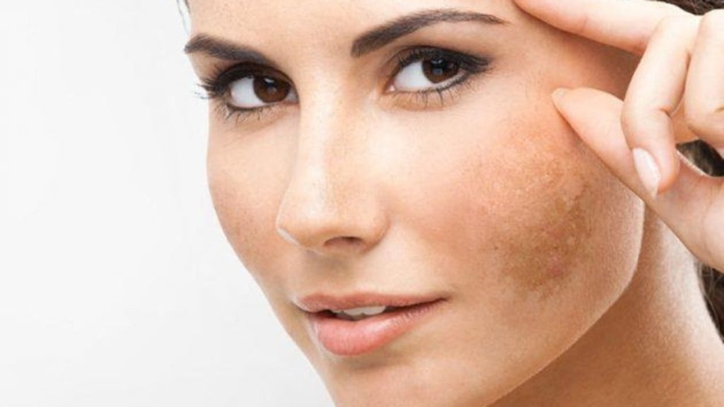 Divulgação Guia do melasma: tudo o que você precisa saber para lidar com a condição que causa manchas escuras na pele