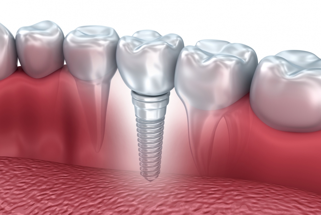 Programa cadastra pacientes para implantes dentários em pós-Graduação na Unimar