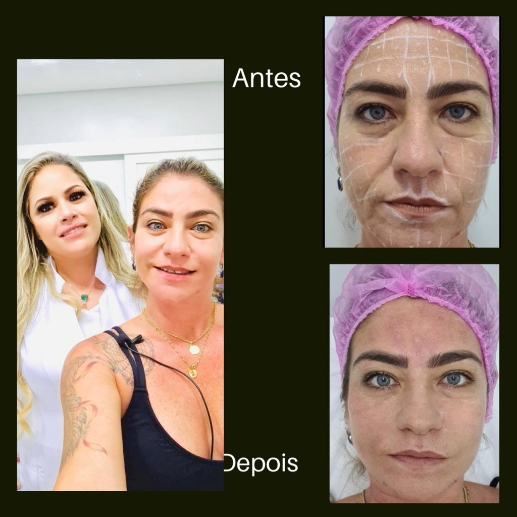 Skinbooster - Método de rejuvenescimento que é a sensação do momento