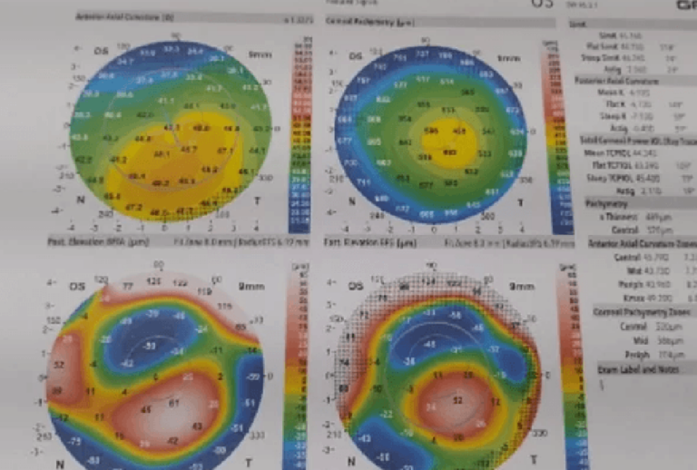 Campanha em Marília pede doações para cirurgias em olhos de rapaz com 28 anos