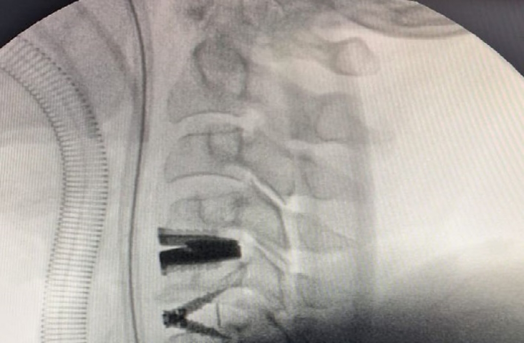 Cirurgia inovadora em Marília implanta prótese de disco na coluna cervical