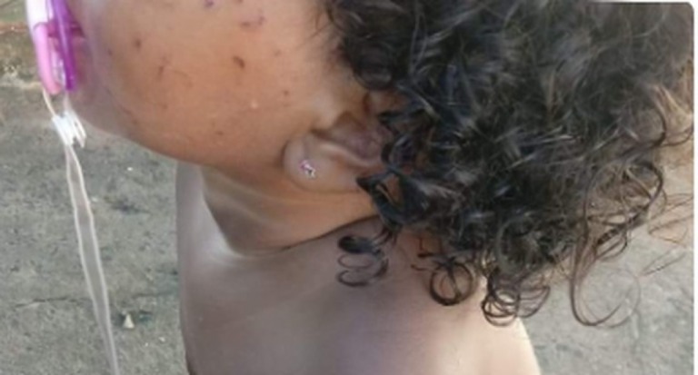 Justiça manda prefeitura indenizar criança arranhada em creche de Marília