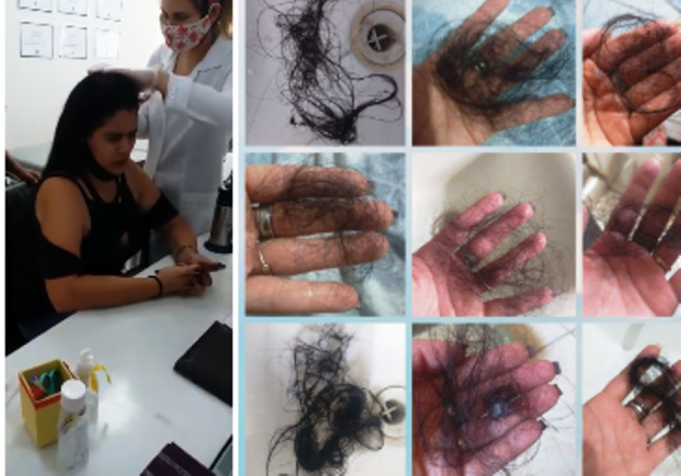 Jovem pede ajuda para tratar caso de alopecia; doença ganhou visibilidade no BBB