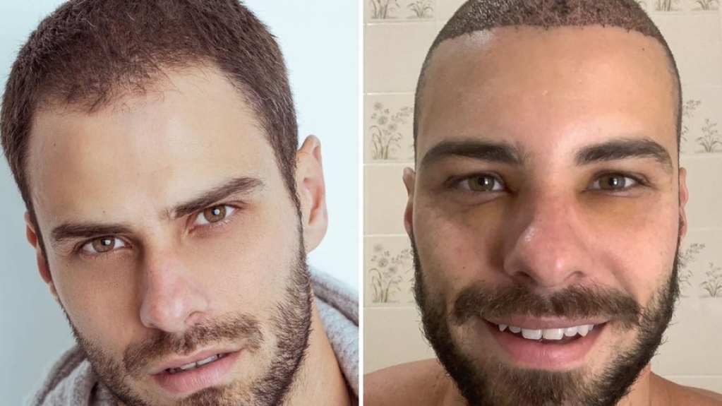 Lucas Malvacini se diz realizado após transplante capilar: "Dia tão esperado" Lucas Malvacini se diz realizado após transplante capilar: "Dia tão esperado"
