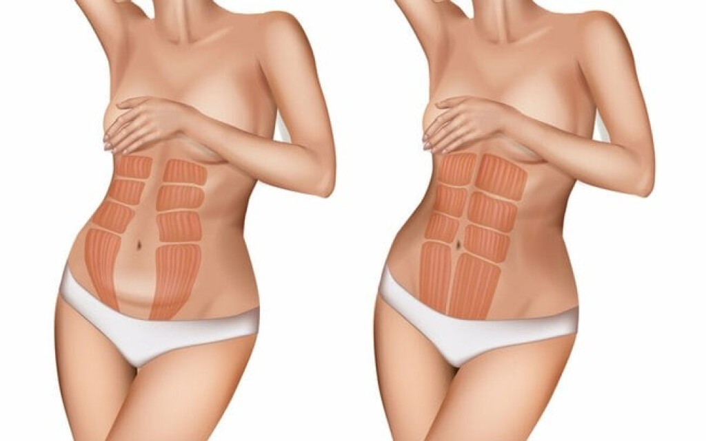 Diástase abdominal: entenda a condição que afeta a influenciadora digital Boca Rosa Diástase abdominal: entenda a condição que afeta a influenciadora digital Boca Rosa