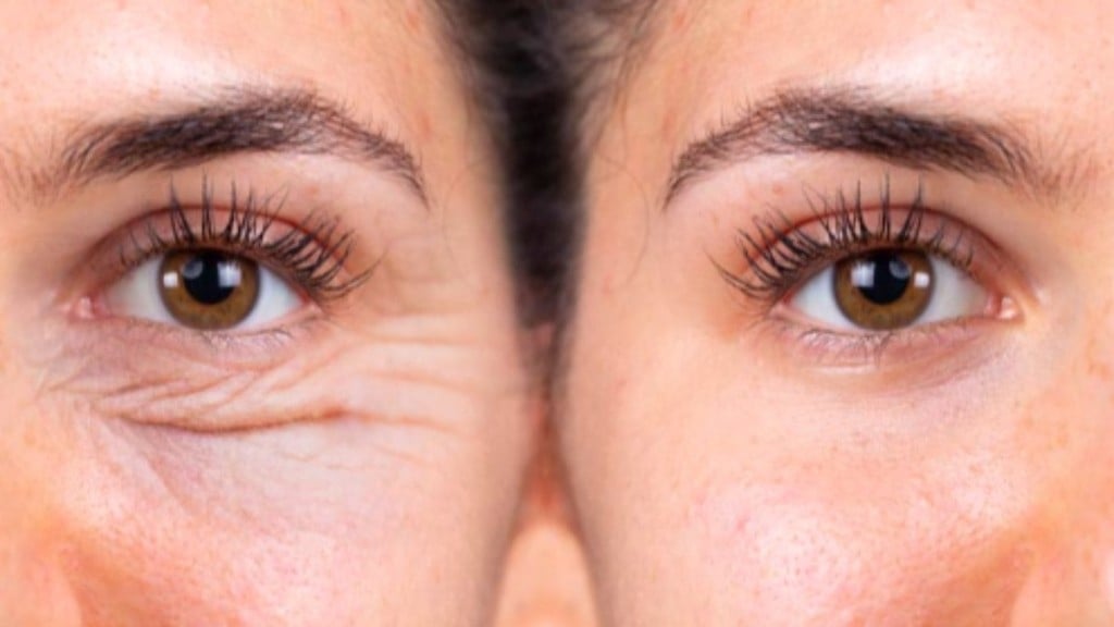 Divulgação Mitos e verdades sobre a blefaroplastia