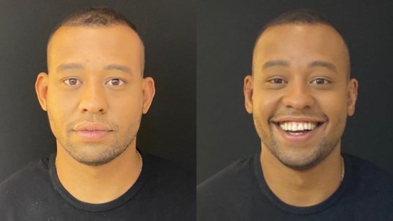 Mussunzinho fez cirurgia na orelha antes do 'Power Couple'; veja