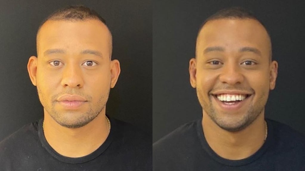 Mussunzinho fez cirurgia na orelha antes do 'Power Couple'; veja