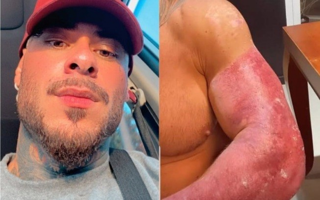 Leo Stronda mostra braço machucado após acidente com botijão de gás Leo Stronda mostra braço machucado após acidente com botijão de gás