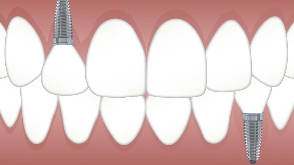 Diabéticos podem colocar implante dental