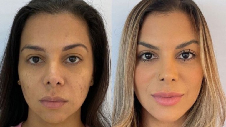 Evelyn Regly faz harmonização facial; confira antes e depois