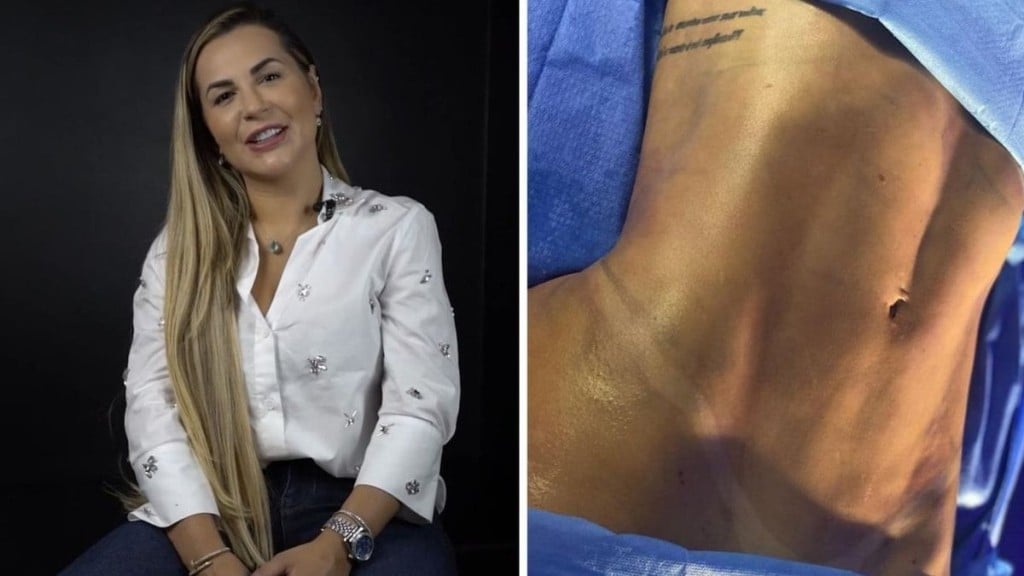 Reprodução/Divulgação Deolane Berreza faz Lipo Lad e impressiona com resultado