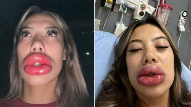 O que pode ter acontecido com americana que fez preenchimento labial