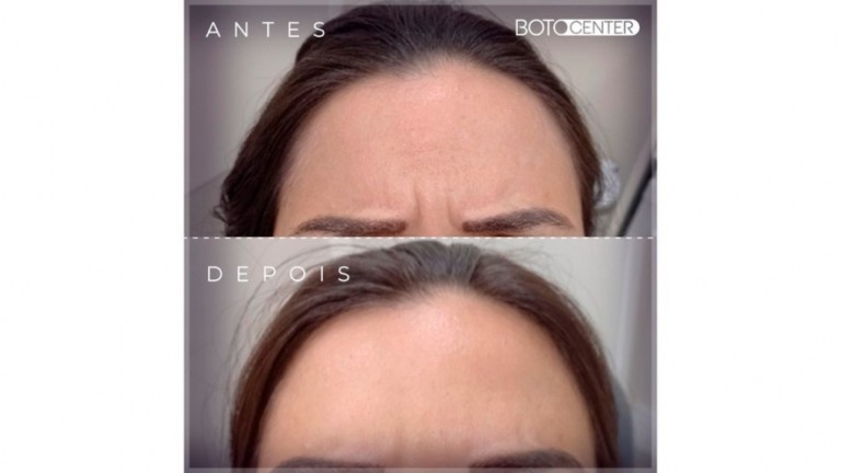Clínica brasileira busca popularizar botox para as classes B e C