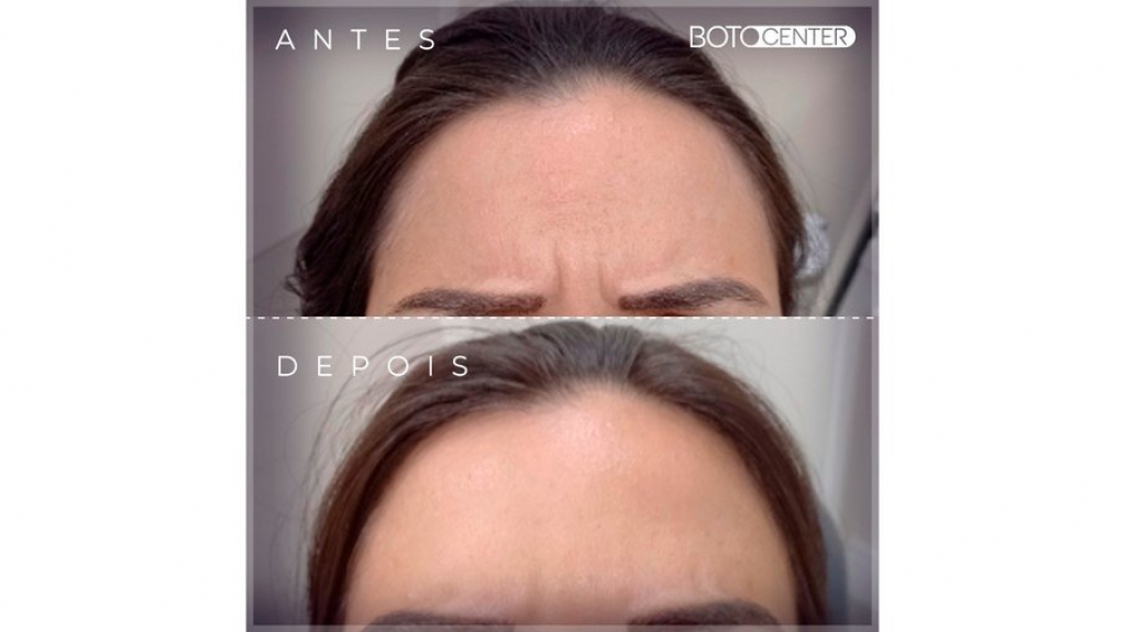 ClÃnica brasileira busca popularizar botox para as classes B e C ClÃnica brasileira busca popularizar botox para as classes B e C