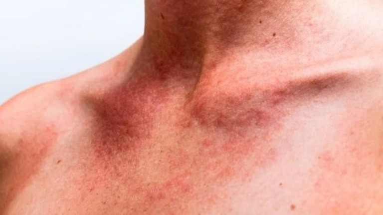 Alergia ao Sol: entenda a doença que atinge 10% da população